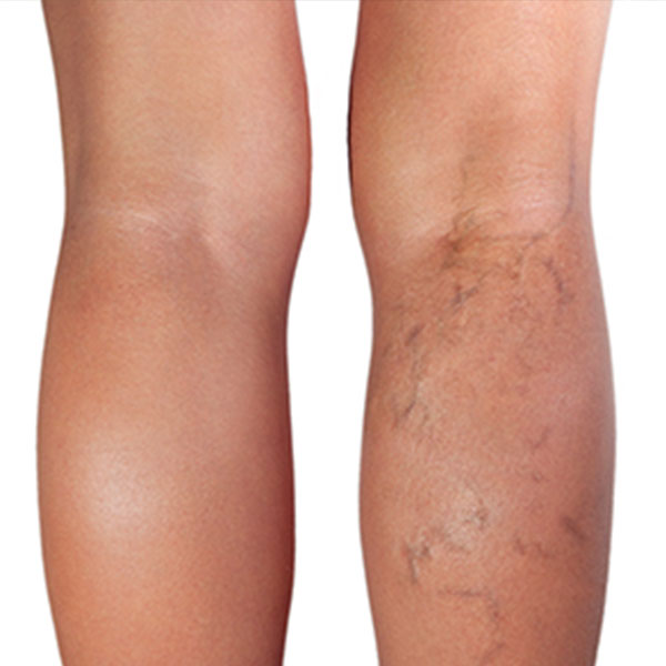 What Are Varicose Veins?