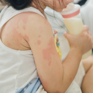 Sesame Seed Allergy